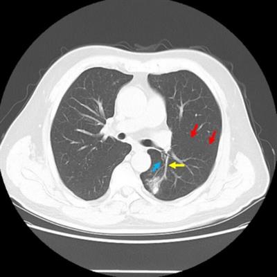 A pulmonary nodule mislocated in “dorsal” segment due to tri-lobed left lung